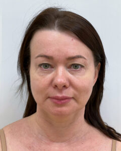 СМАС лифтинг - до