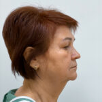 Тотальное омоложение - до