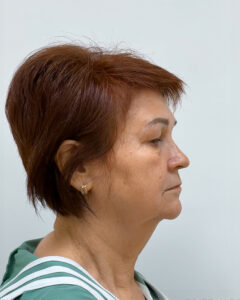 Тотальное омоложение - до