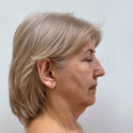 СМАС лифтинг - до