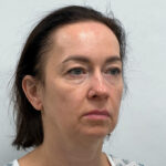 Тотальное омоложение - до