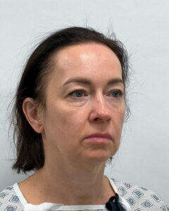 Тотальное омоложение - до