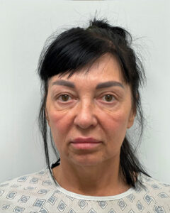 Тотальное омоложение - до