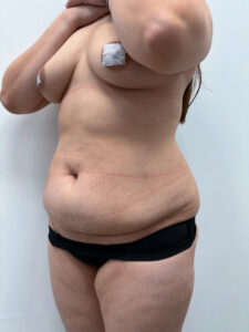 Липосакция - до