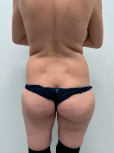 Липосакция - до