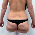 Липосакция - до