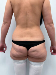 Липосакция - до