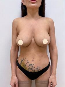 Реэндопротезирование - до