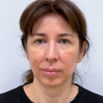 Верхняя блефаропластика с эндоскопическим лифтингом - до