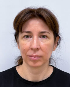 Верхняя блефаропластика с эндоскопическим лифтингом - до