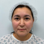 Верхняя блефаропластика с эндоскопическим лифтингом - до