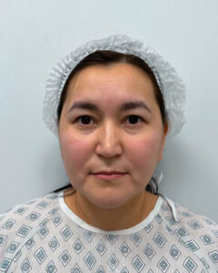 Верхняя блефаропластика с эндоскопическим лифтингом - до