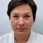 Эндоскопический лифтинг с круговой блефаропластикой - до