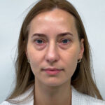 Трансконъюнктивальная блефаропластика - до