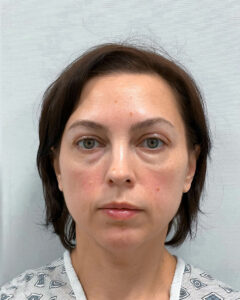 Трансконъюнктивальная блефаропластика - до