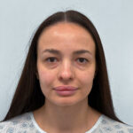 Трансконъюнктивальная блефаропластика - до