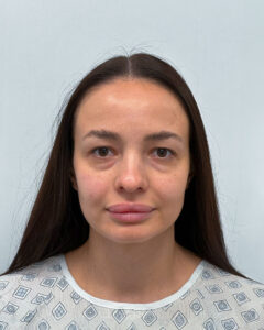 Трансконъюнктивальная блефаропластика - до