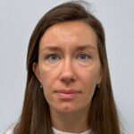 Трансконъюнктивальная блефаропластика - до