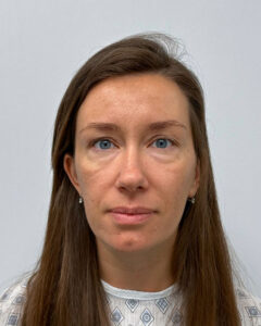 Трансконъюнктивальная блефаропластика - до