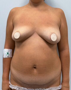 Маммопластика подтяжка в сочетании с пластикой живота - до