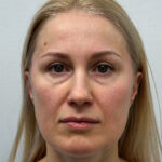 Эндоскопический лифтинг с нижней блефаропластикой и липофилингом в область верхних век - до