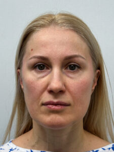 Эндоскопический лифтинг с нижней блефаропластикой и липофилингом в область верхних век - до