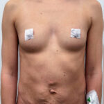 Маммопластика и абдоминопластика с ликвидацией двух грыж. - до