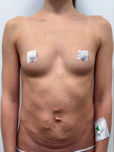 Маммопластика и абдоминопластика с ликвидацией двух грыж. - до