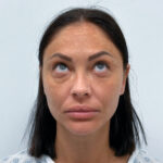 Нижняя блефаропластика - до