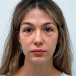 Нижняя блефаропластика - до