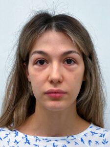 Нижняя блефаропластика - до