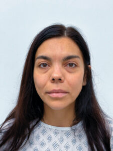 Нижняя блефаропластика - до