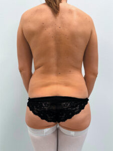 Бодилифтинг - до