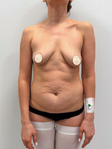 Подтяжка + бодилифт - до