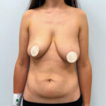 Маммопластика подтяжка + бодилифт - до