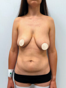 Маммопластика подтяжка + бодилифт - до