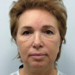 Тотальное омоложение лица - до