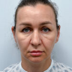 Тотальное омоложение - до