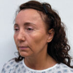 Тотальное омоложение лица - до