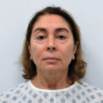 Тотальное омоложение лица - до