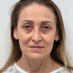 Эндоскопический лифтинг в сочетании блефаропластикой - до