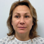 Эндоскопический лифтинг в сочетании блефаропластикой - до