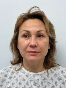 Эндоскопический лифтинг в сочетании блефаропластикой - до