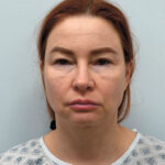 Эндоскопический лифтинг в сочетании блефаропластикой - до