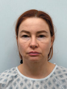 Эндоскопический лифтинг в сочетании блефаропластикой - до