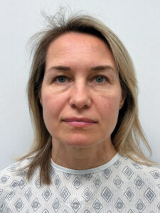 Эндоскопический лифтинг в сочетании блефаропластикой - до