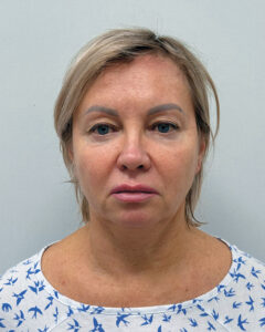 Комплексное омоложение лица - до