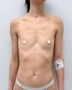 Маммопластика увеличение - до