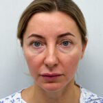 Трансконъюнктивальная блефаропластика - до