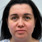 Эндоскопический лифтинг с блефаропластикой - до